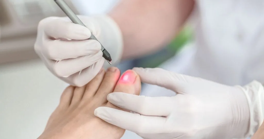 Tratamiento Láser Uñas